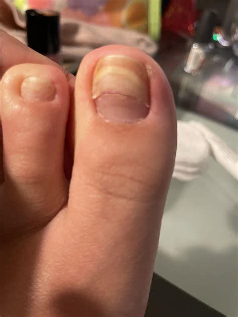 Shocking Fact: Toenail Growing Under Toenail May Signal Infection