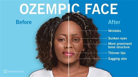 What Is Ozempic Face And How To Prevent It What Is Ozempic Face And How To Prevent It